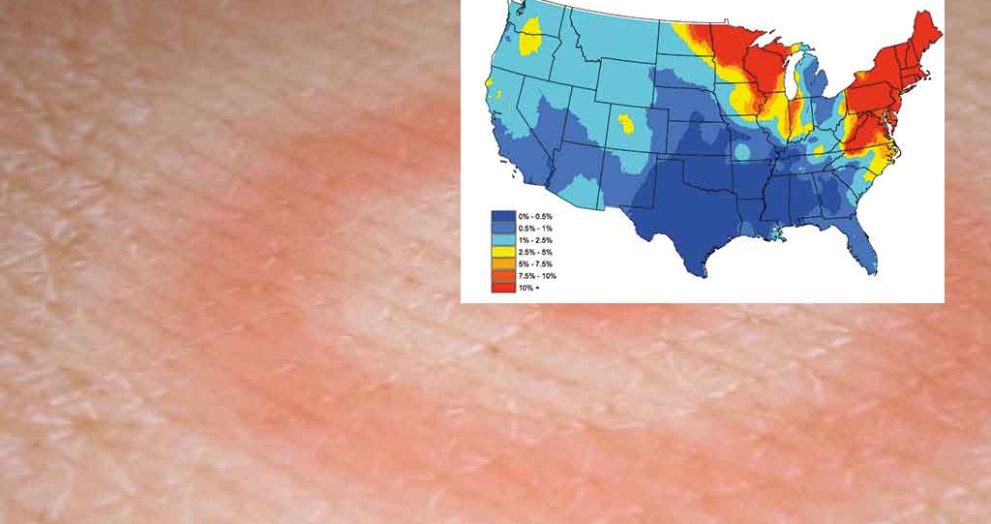 Lyme Disease in America