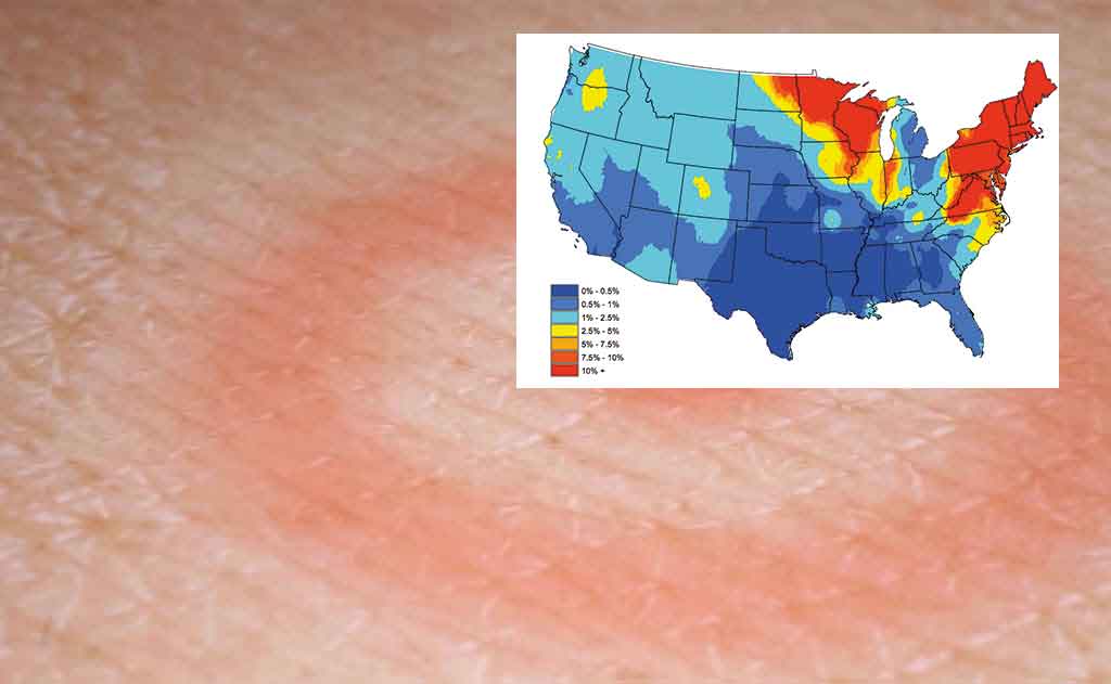Lyme Disease in America